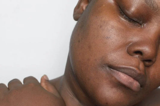 Pourquoi le contour de ma bouche est plus foncé ? Comprendre l’hyperpigmentation péribuccale
